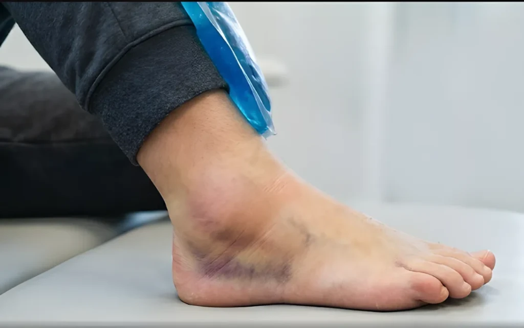 AnkleSprain