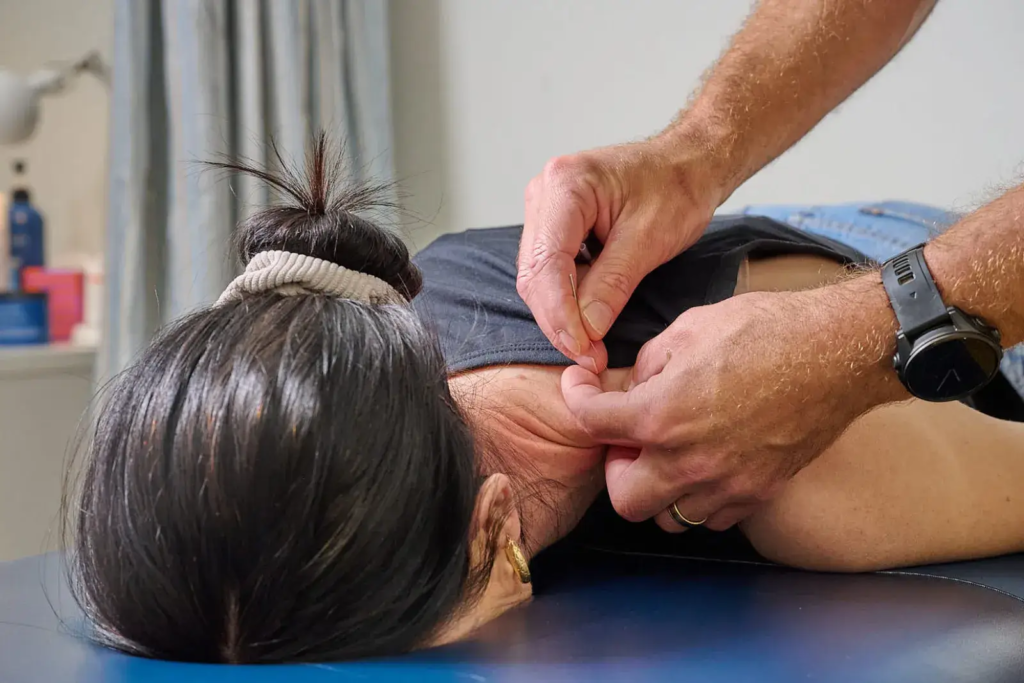 Dry Needling Physio in Sutherland